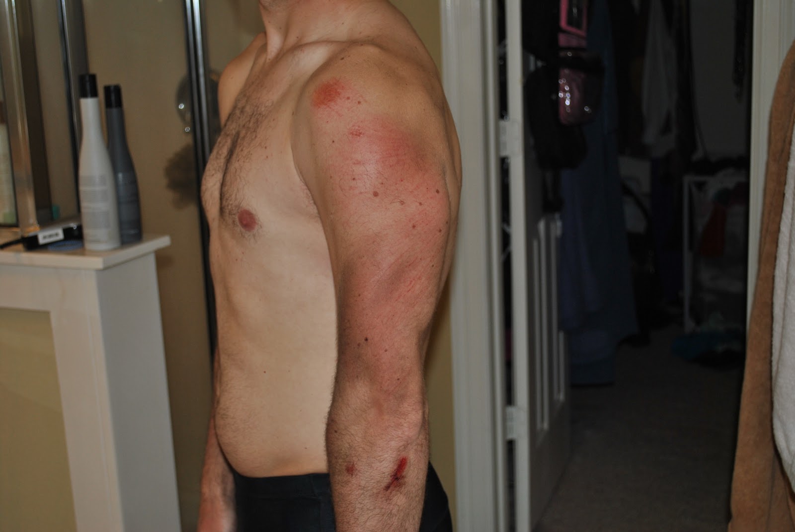 Dangle the Carrot An Endurance Sports Blog My Bike Crash and Road