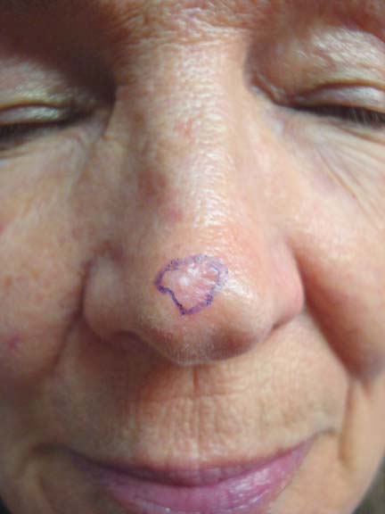 Fibrofolliculoma - Skin conditions - Condition | Our Health