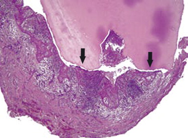Periapical Abscess Histology