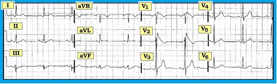 ECG Interpretation: August 2012