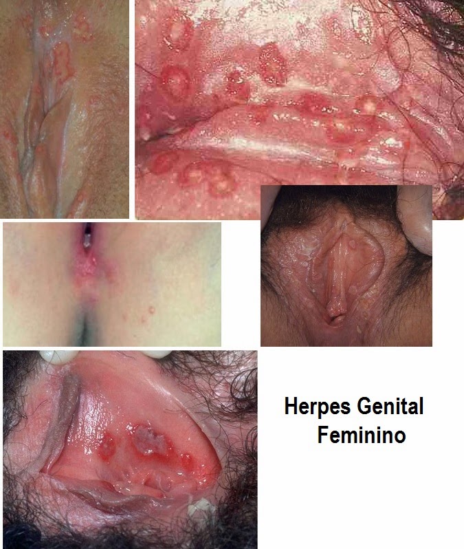 Herpes Around the Anus - www.HemorrhoidsHemroids.com