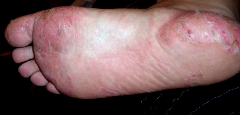 Small bubbles on my foot - Dermatology - MedHelp
