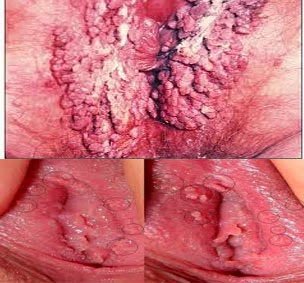 Cara Mudah Menyembuhkan Bintik Kutil Di Kemaluan Cara Mudah Menyembuhkan Bintik Kutil Di Kemaluan