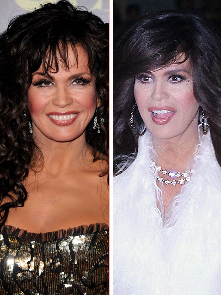 Marie Osmond Plastic Surgery.