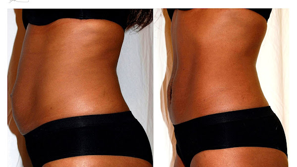 Laser Lipo Before And After One Treatment