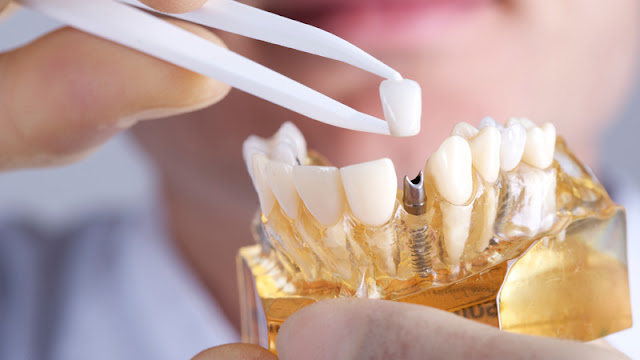 http://www.chennaidentalclinic.in/dental-implants.html