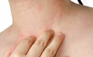 Dengue, Zika e Chikungunya: Você sabe a diferença entre elas?