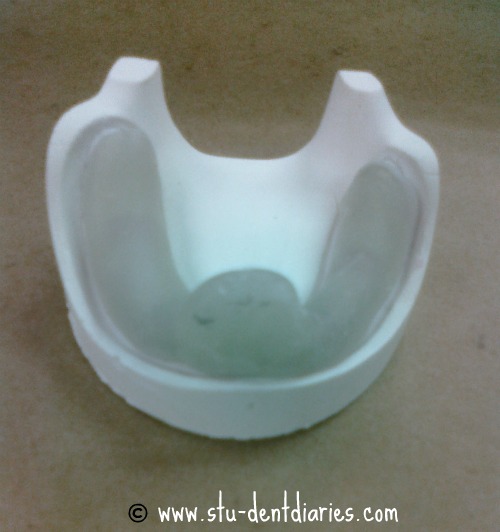 StuDENT Diaries Custom Tray, Record Base and Wax Rim