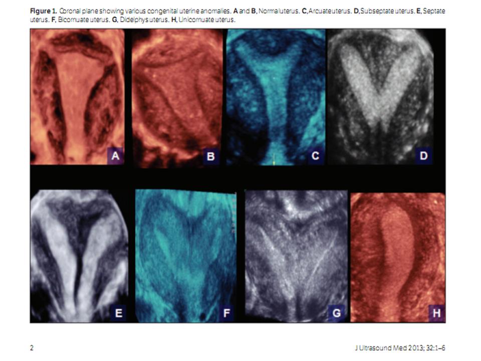 BÀI SOẠN VỀ SIÊU ÂM CHẨN ĐOÁN: 3D US for Uterine Anomalies: The Z Technique