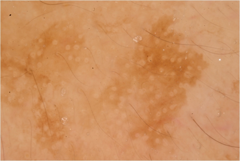 Dermatoscopia Motheaten borders