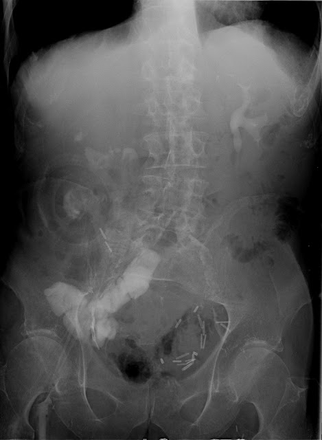 Topics in Radiography: Loopogram