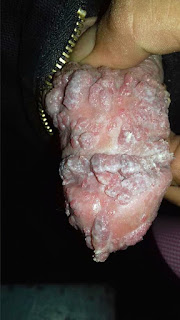 Obat Kutil Di Kemaluan Pria Obat Kutil Di Kemaluan Pria