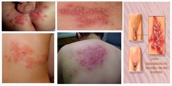 herpes obat salep herpes