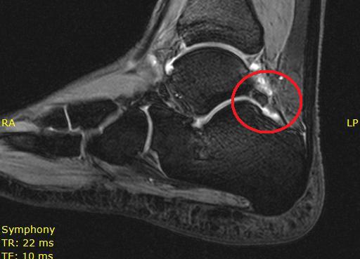 Little Bone, Big Problems: Funny Bone