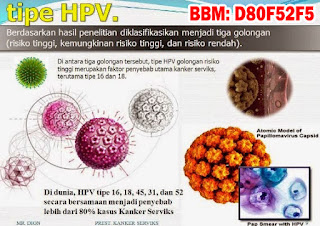 Obat Kutil Kelamin, Cara Mengobati Kutil Dikemaluan Kelamin Dari Rumah Sendiri, Dokter Obat Kutil Kelamin Terbukti Terbaik Dan Terpercaya Obat Kutil Kelamin, Cara Mengobati Kutil Dikemaluan Kelamin Dari Rumah Sendiri, Dokter Obat Kutil Kelamin Terbukti Terbaik Dan Terpercaya