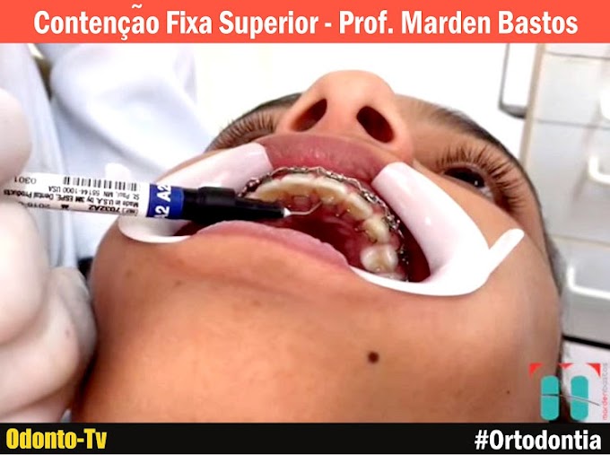 ORTODONTIA: Contenção Fixa Superior - Prof. Marden Bastos