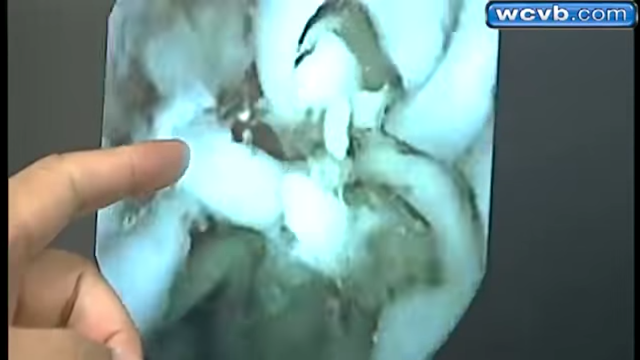 Video Kondisi Perut Setelah Makan Mie Instant Video Kondisi Perut Setelah Makan Mie Instant