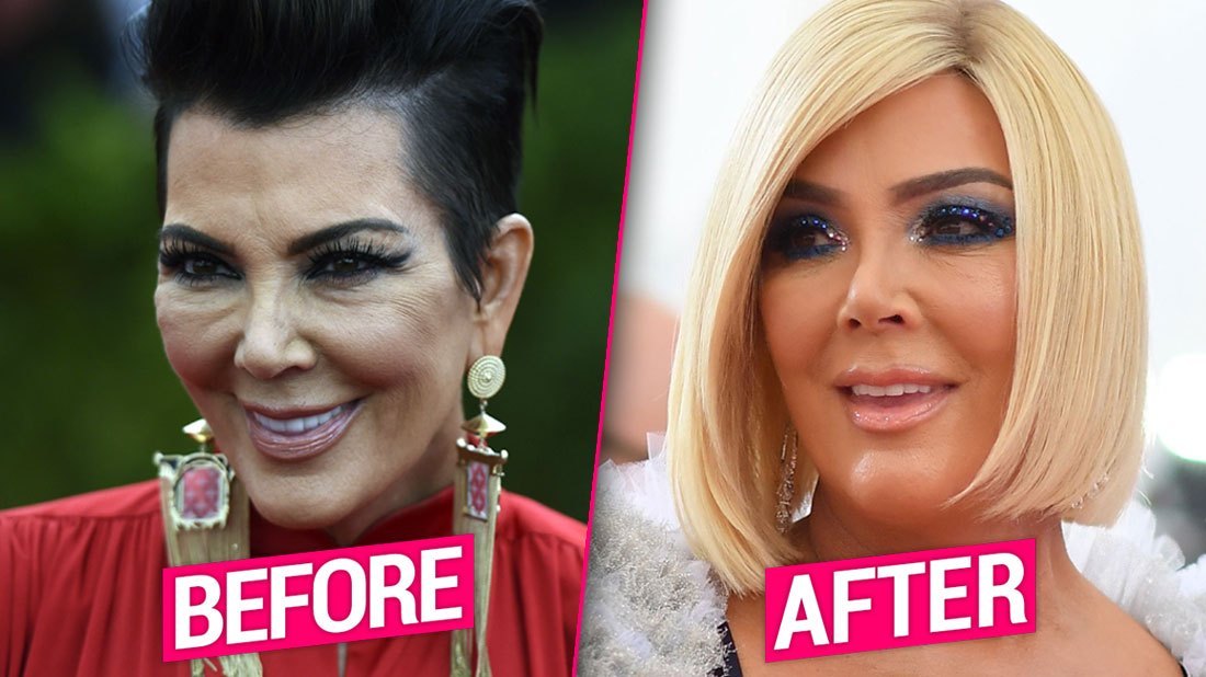 Photos Kris Jenner Debuts Brand New Face After Invasive Plastic
