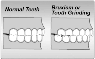 Bruxism Treatment