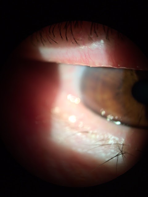 The Latest Treatment For Dry Eyes At Bedford Family Eye Care