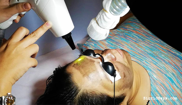 Hollywood laser facial treatment - Nd YAG laser - Bacolod derma - Bacolod dermatologist - beauty - Bacolod dermclinic - facial laser treatment - Bacolod facial laser treatment - Hollywood laser in Bacolod - Bacolod blogger