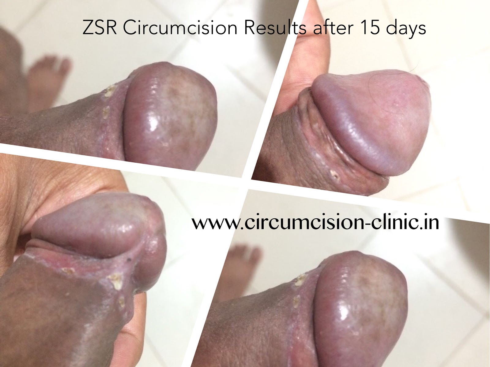 www.circumcision-clinic.in.