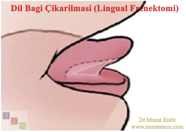 Dil bağının çıkarılması - Dil bağı dokusunun çıkarılması - Dil bağı tedavisi - Lingual frenektomi - Dil altı bağı çıkarılması - Dil altı bağı operasyonu