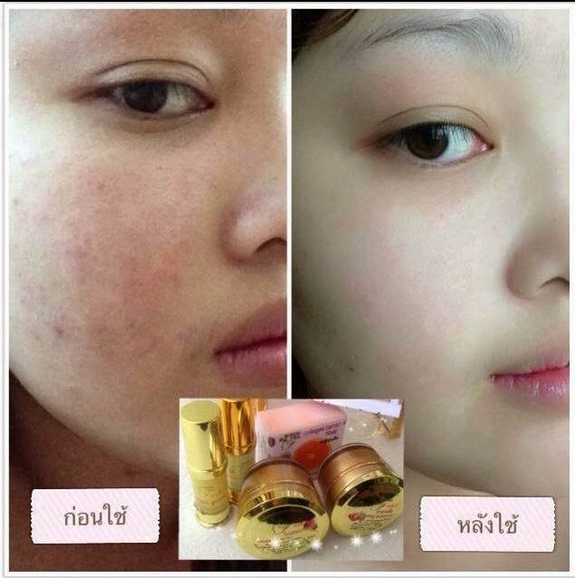 1 Thailand Skin Whitening Products Freshy Face Gold Set Users Before and After Photos