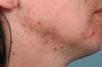 Comment l'acné est causée