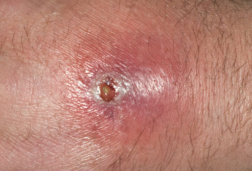 Deadly skin infection? 12 graphic photos that could save ...