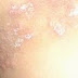Apa Yang Dimaksud Dengan Penyakit Eksim Atau Dermatitis