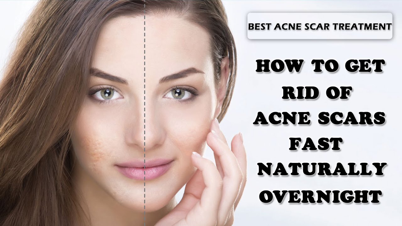 How To Remove Burn Marks Naturally How To Remove Burn Marks Naturally