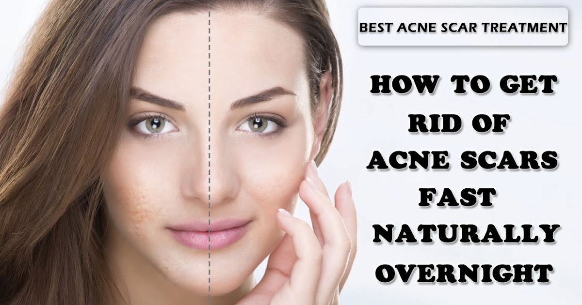 How To Make Remove Acne Scars Naturally How To Make Remove Acne Scars Naturally