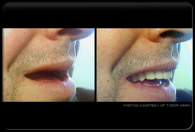 Prothèses dentaires photo avant et après