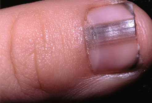 fingernail cancer