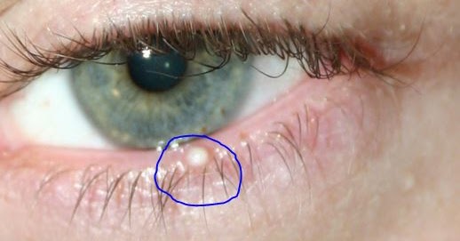 Obat Timbilen Yang Ada Di Apotik Paling Ampuh Obat Timbilen Yang Ada Di Apotik Paling Ampuh