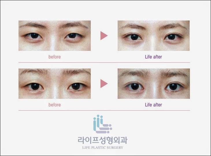 LIFE Plastic Surgery, Korea [LIFE Plastic Surgery] Eye Bag Removal