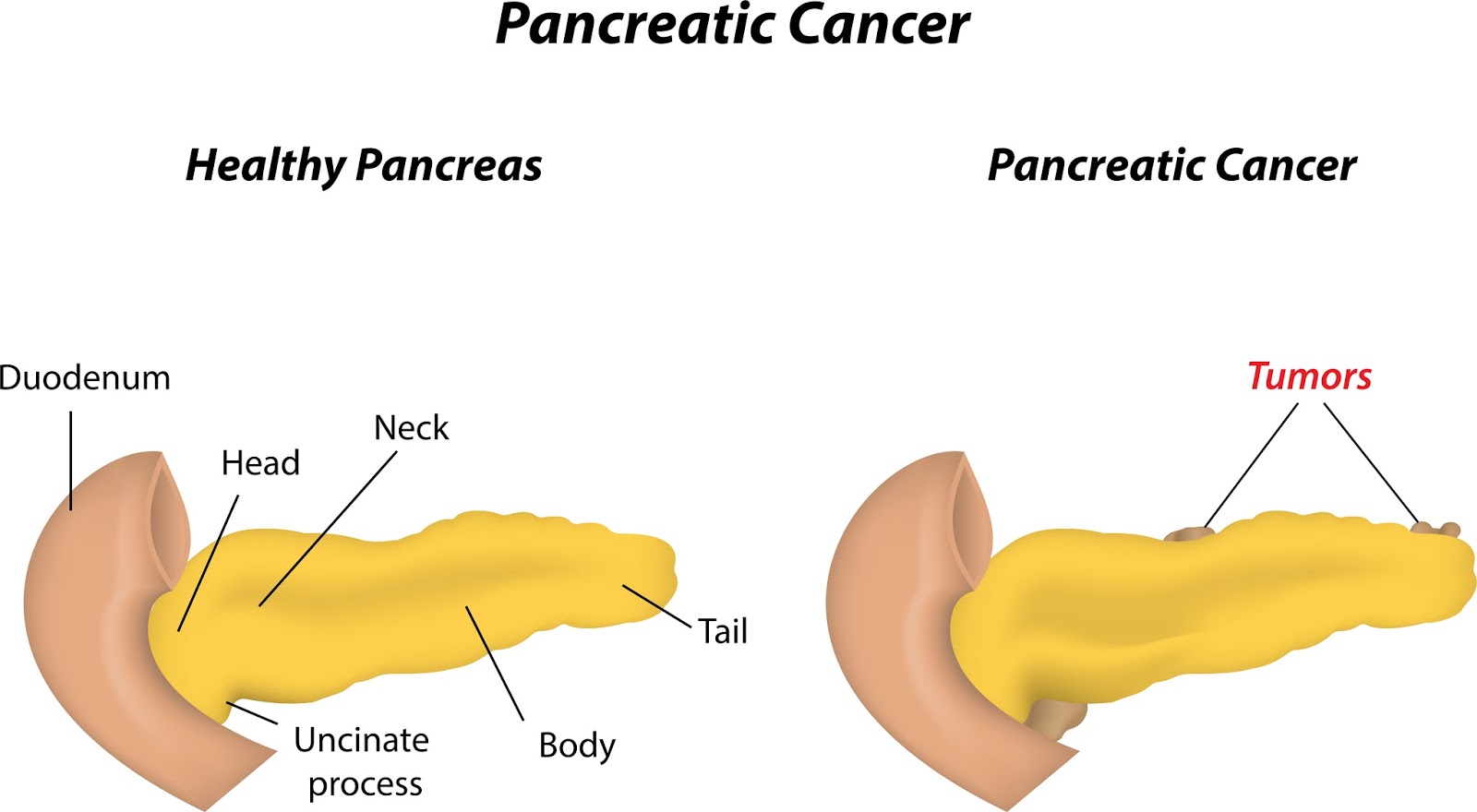 Панкреатит головка. Поджелудочной железы (опухоли и панкреатит);. Симптомы хронического панкреатита поджелудочной железы. Раковая опухоль поджелудочной железы. Хронические заболевания поджелудочной железы.