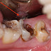 Răng hàm sâu có nên nhổ không?