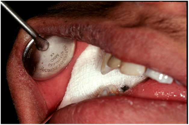 Oral Hemorrhage 11