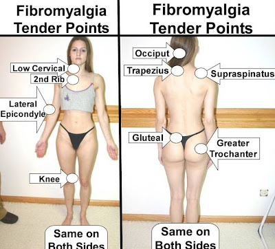 fibromyaliga