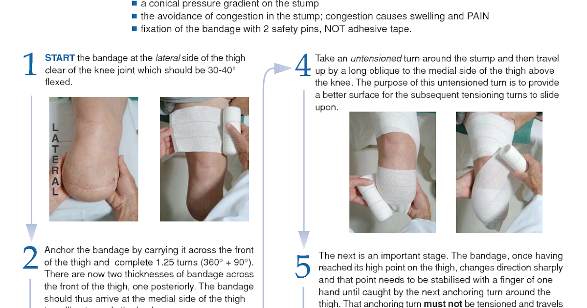 EXCLUSIVE PHYSIOTHERAPY GUIDE FOR PHYSIOTHERAPISTS: STUMP BANDAGING FOR ...