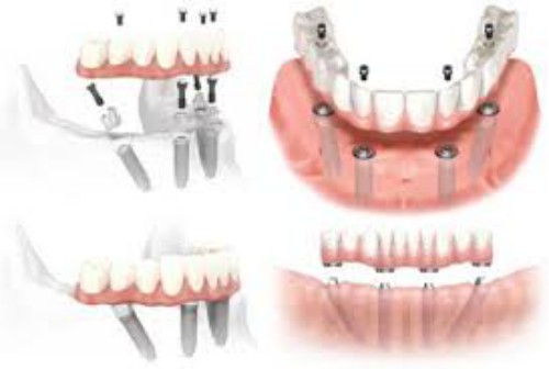 Trồng răng implant ở đâu tốt