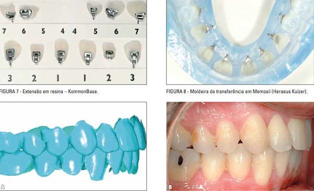 ORTODONTIA CONTEMPORÂNEA: Tecnologias digitais e sistemas CAD/CAM ...