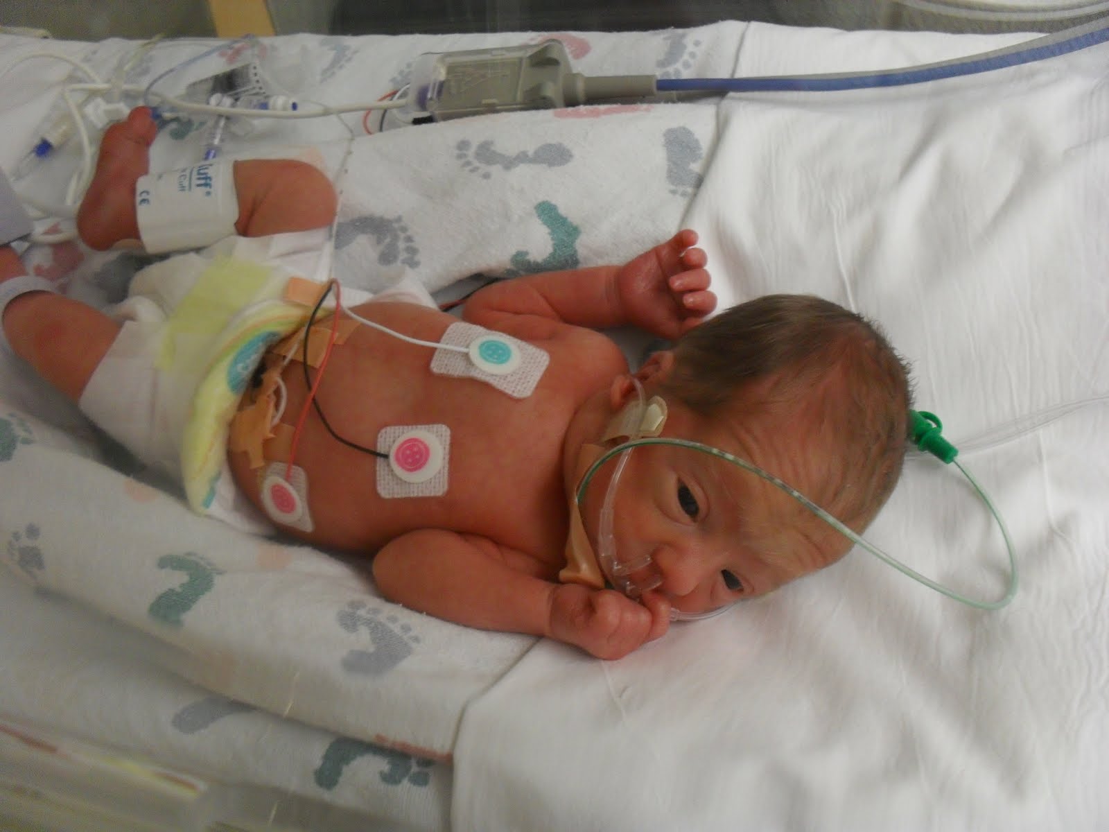 Derek's Journey Diagnosed with NEC