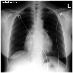 Radiografi dada tamponade jantung efusi perikardial chest radiography rontgen x-ray antero posterior cardiac tamponade pericardial effusion