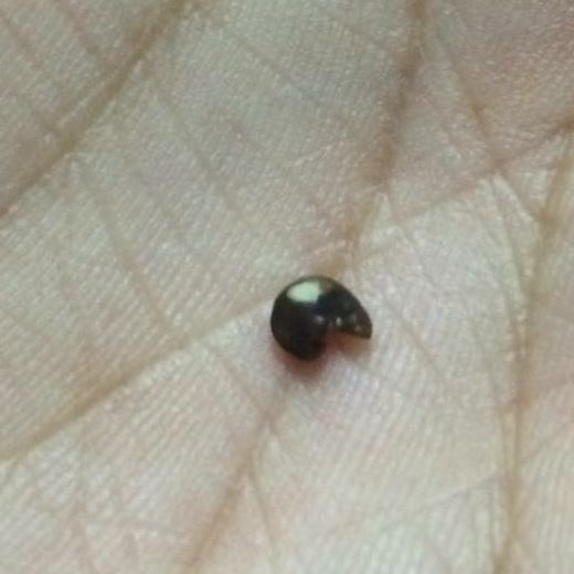 the other song Kidney stones and homoeopathy A smooth passage for