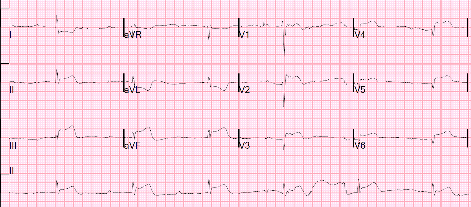 Dr. Smith's ECG Blog Acute chest pain, bradycardia, and hypotension