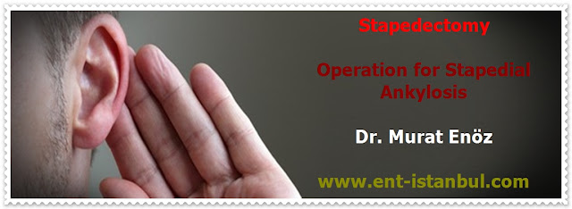 Stapedectomy Operation - Total Stapedectomy - Partial Stapedectomy - Stapedotomy - Stapedial Ankylosis - Preoperative Diagnostic Procedures For Stapedectomy - Indications For Stapedectomy Operation - Contrandications For Stapedectomy Operation - Stapedectomy Technique - Stapedectomy by using Titanium Piston - Stapedectomy Risks & Complications - Postoperative Patient Care For Stapedectomy