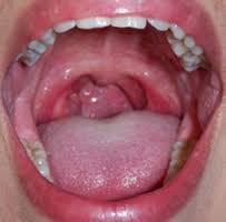 Throat Cancer Picture